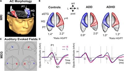 Neuromorphological and Neurofunctional Correlates of ADHD and ADD in the Auditory Cortex of Adults